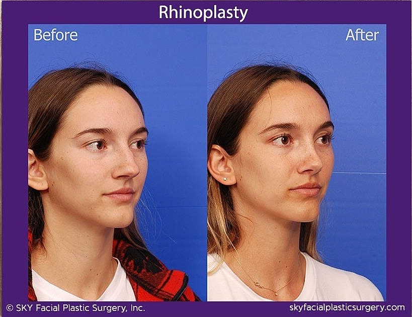 Rhinoplasty Before & After