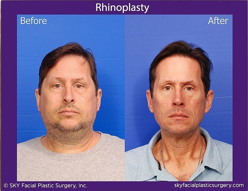 Rhinoplasty Before & After