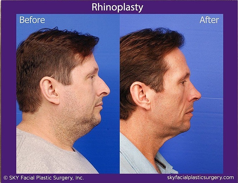 Rhinoplasty Before & After