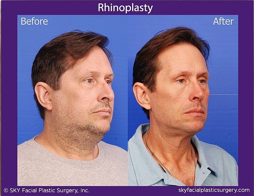 Rhinoplasty Before & After