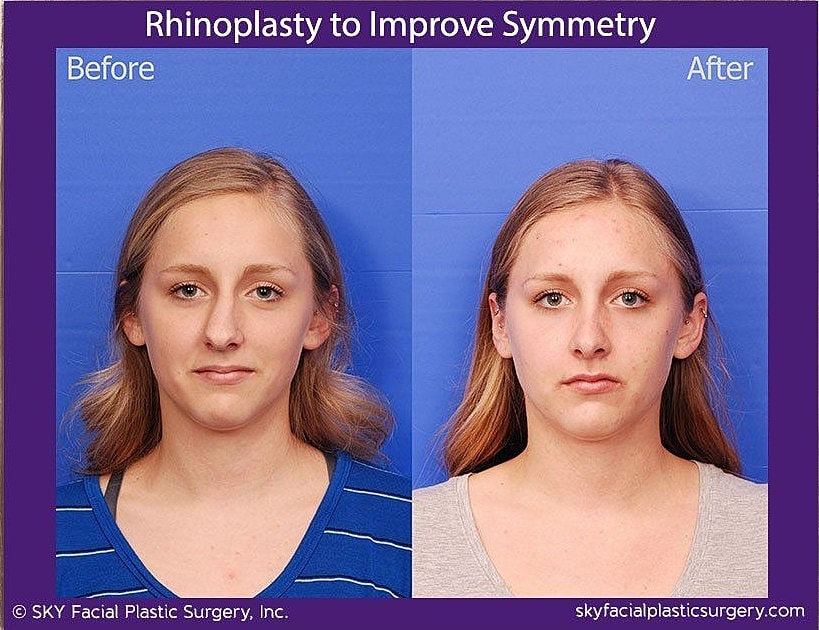 Rhinoplasty Before & After