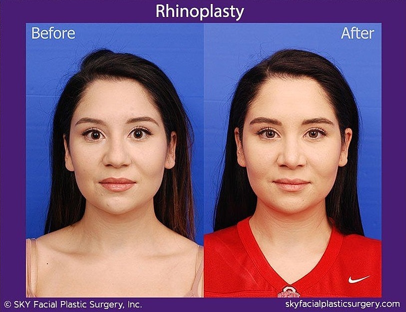 Rhinoplasty Before & After