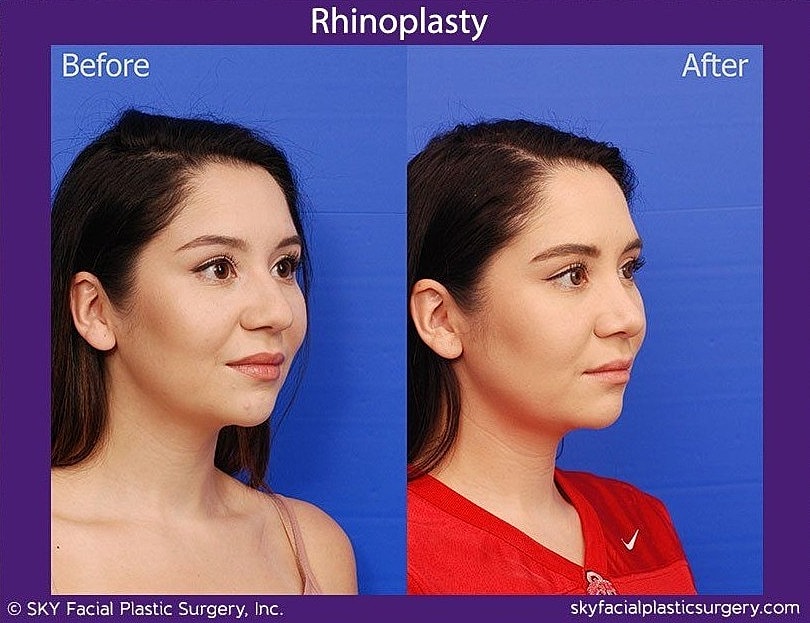 Rhinoplasty Before & After
