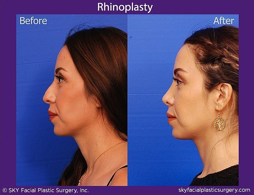 Rhinoplasty Before & After
