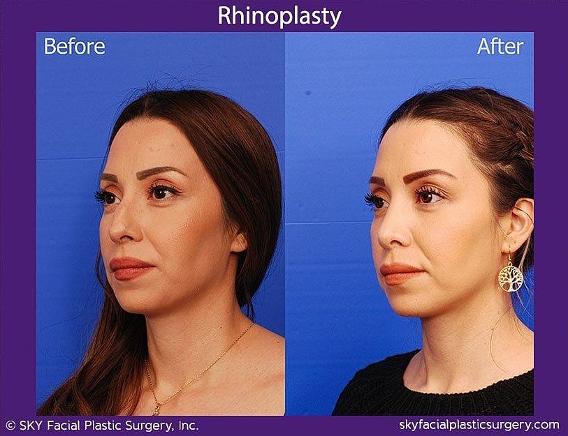 Rhinoplasty Before & After