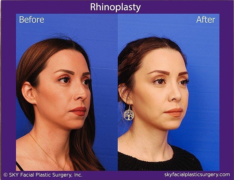 Rhinoplasty Before & After