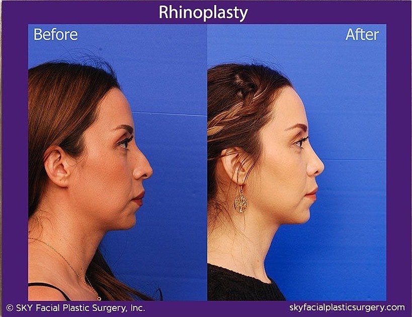 Rhinoplasty Before & After