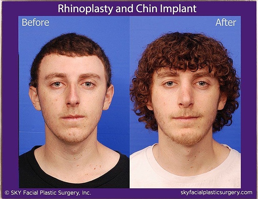 Rhinoplasty Before & After