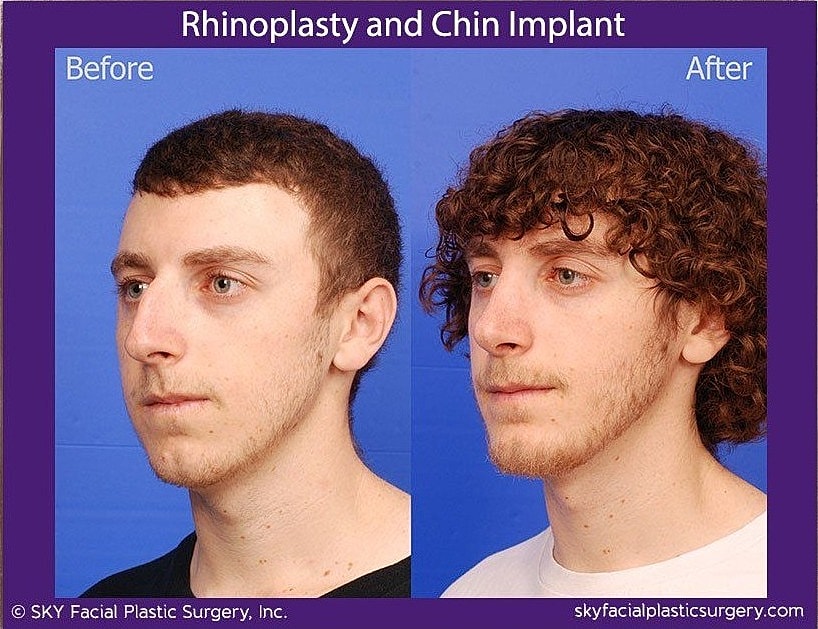 Rhinoplasty Before & After