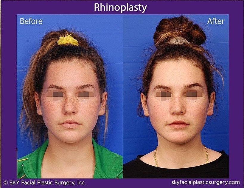 Rhinoplasty Before & After