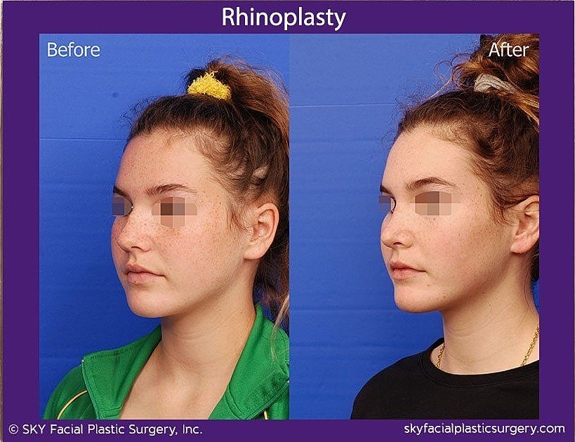 Rhinoplasty Before & After