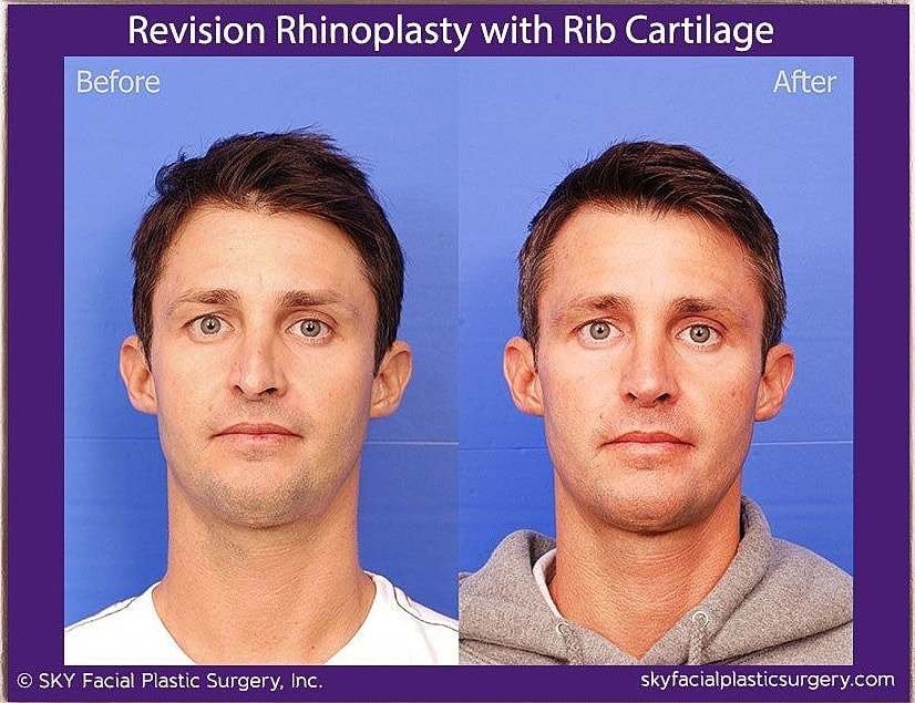 Rhinoplasty Before & After