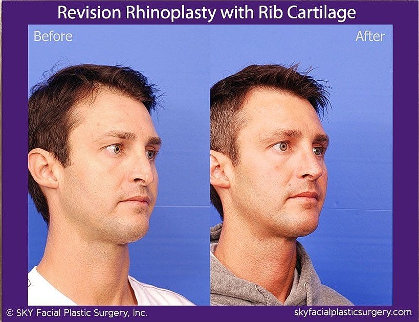 Rhinoplasty Before & After