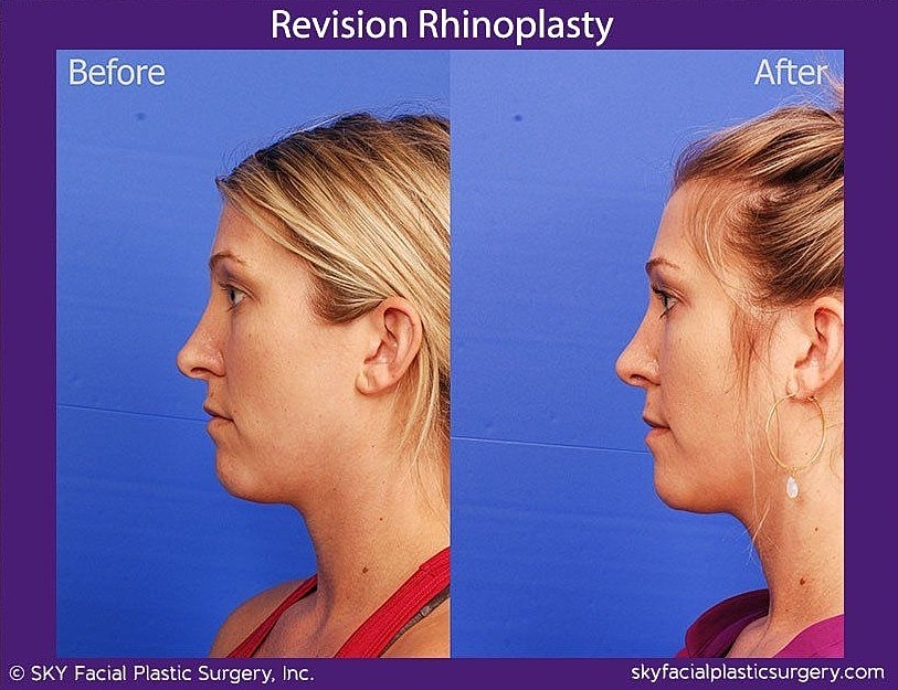 Rhinoplasty Before & After