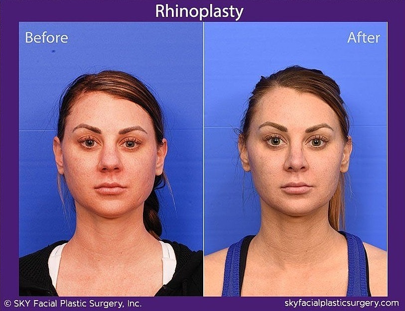 Rhinoplasty Before & After