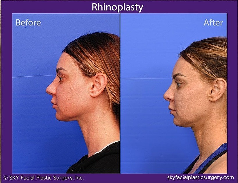 Rhinoplasty Before & After