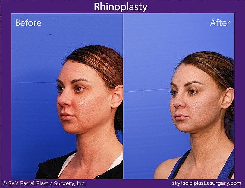Rhinoplasty Before & After