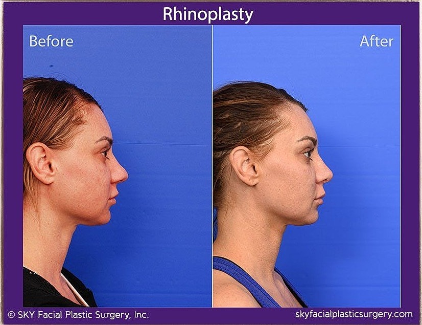 Rhinoplasty Before & After