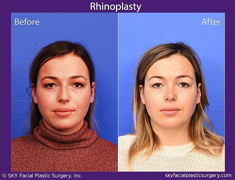 Rhinoplasty Before & After