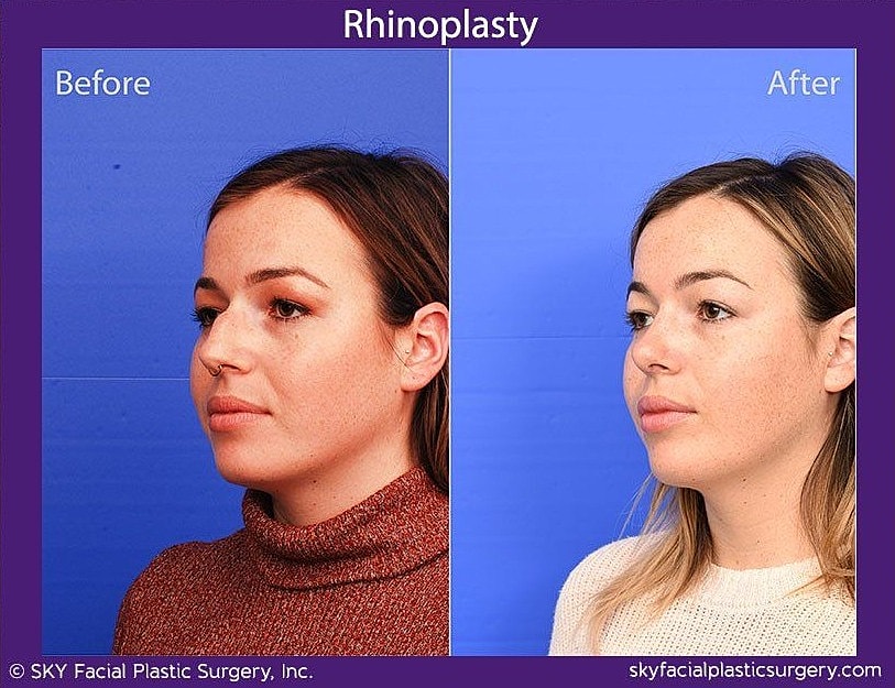 Rhinoplasty Before & After