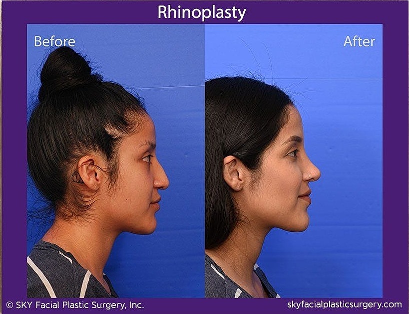 Rhinoplasty Before & After