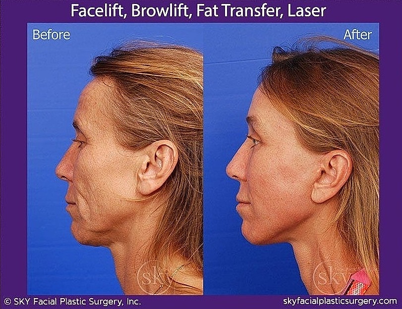 Facelift Before & After