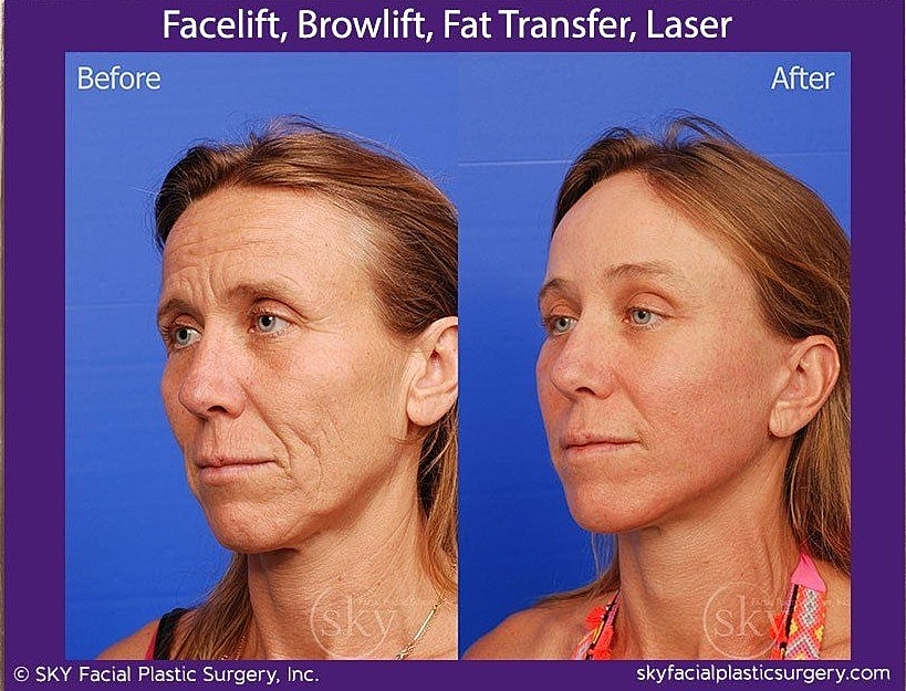 Facelift Before & After
