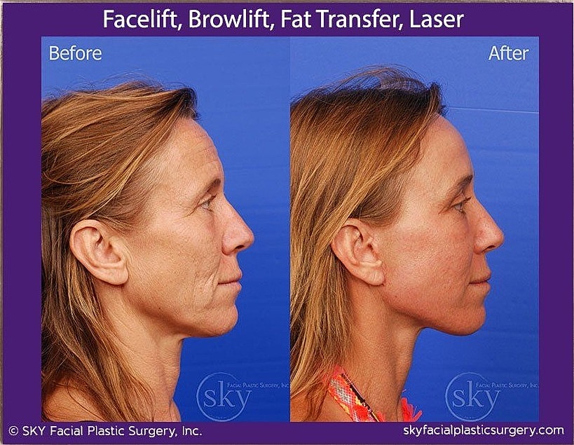 Facelift Before & After