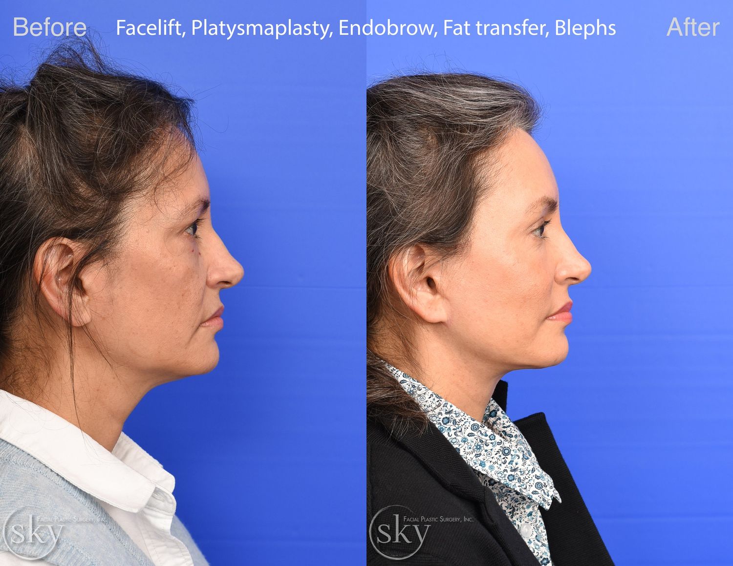 Facelift Before & After