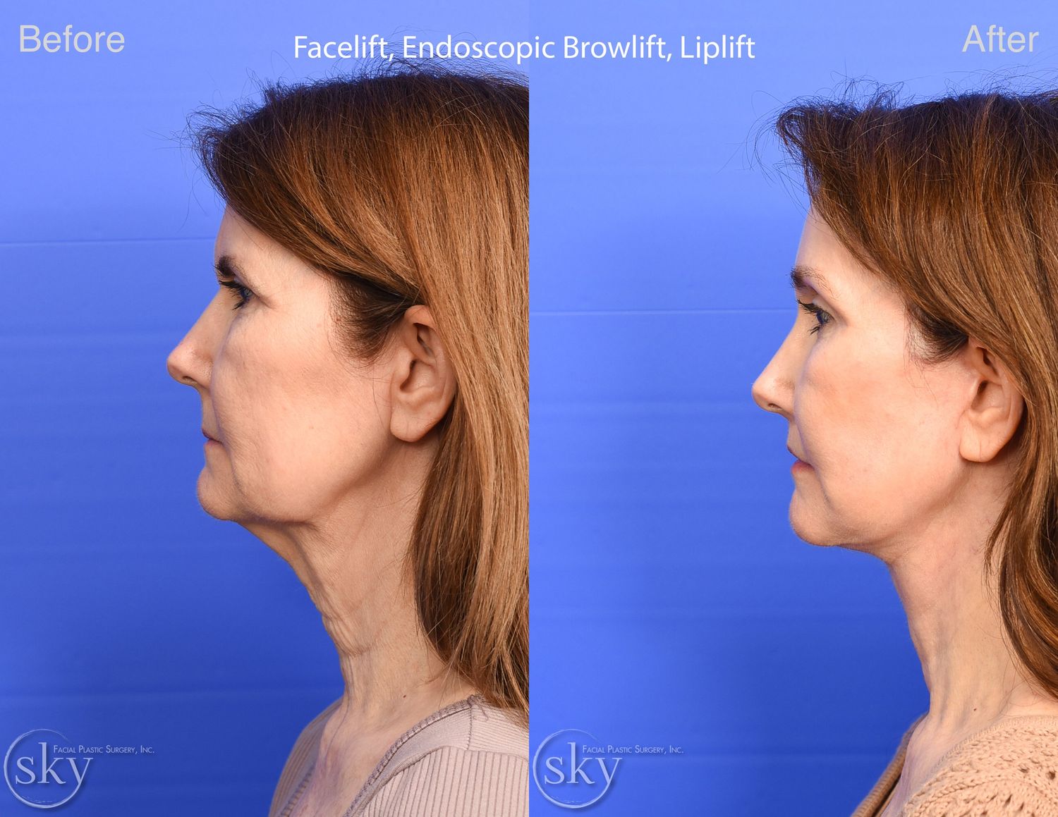 Facelift Before & After