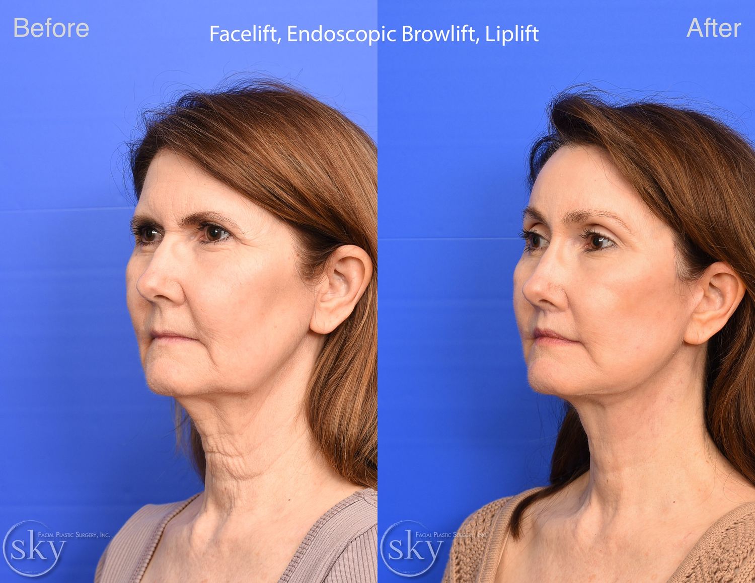 Facelift Before & After