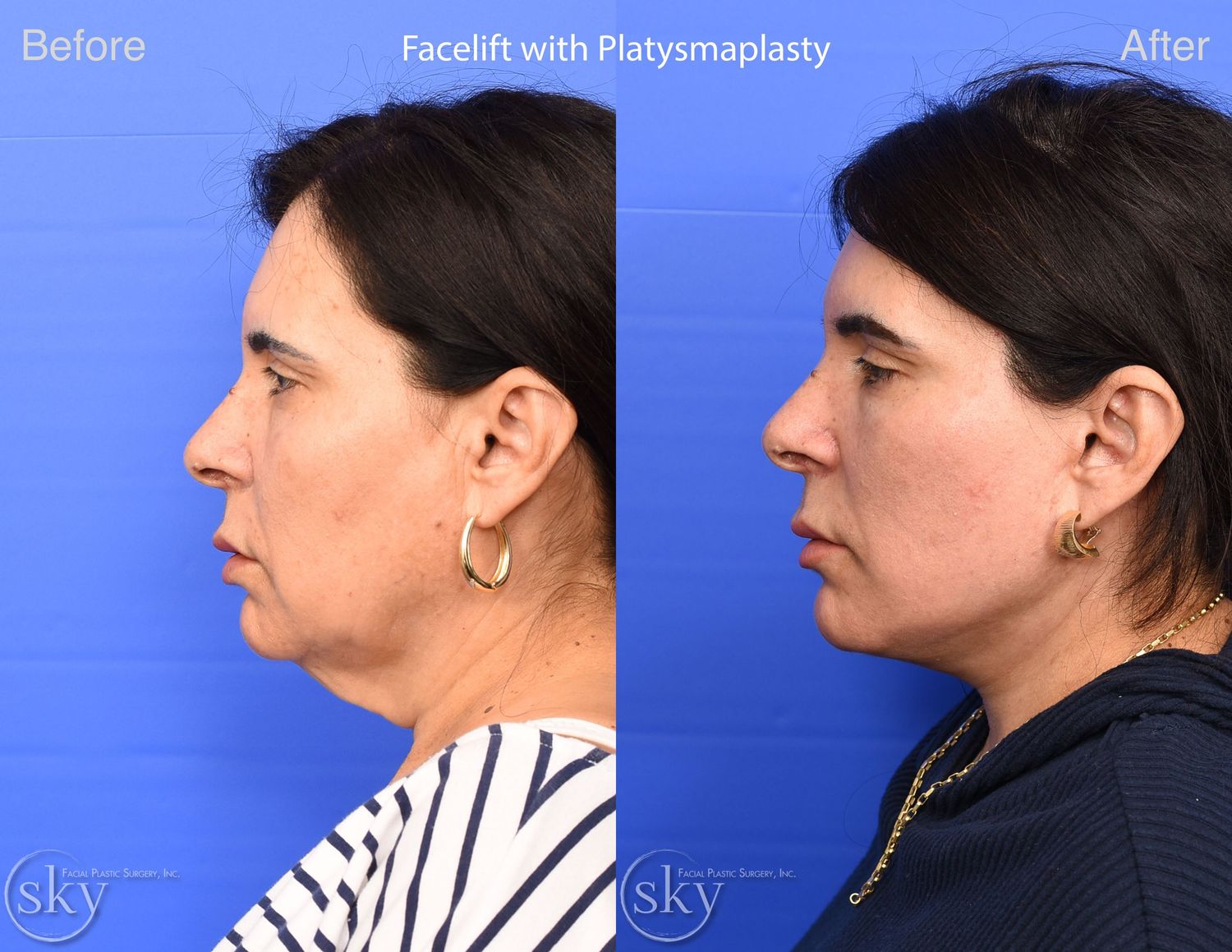 Facelift Before & After