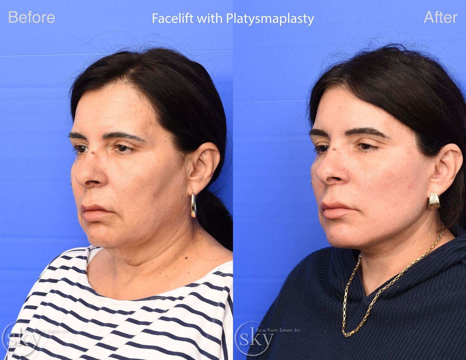 Facelift Before & After