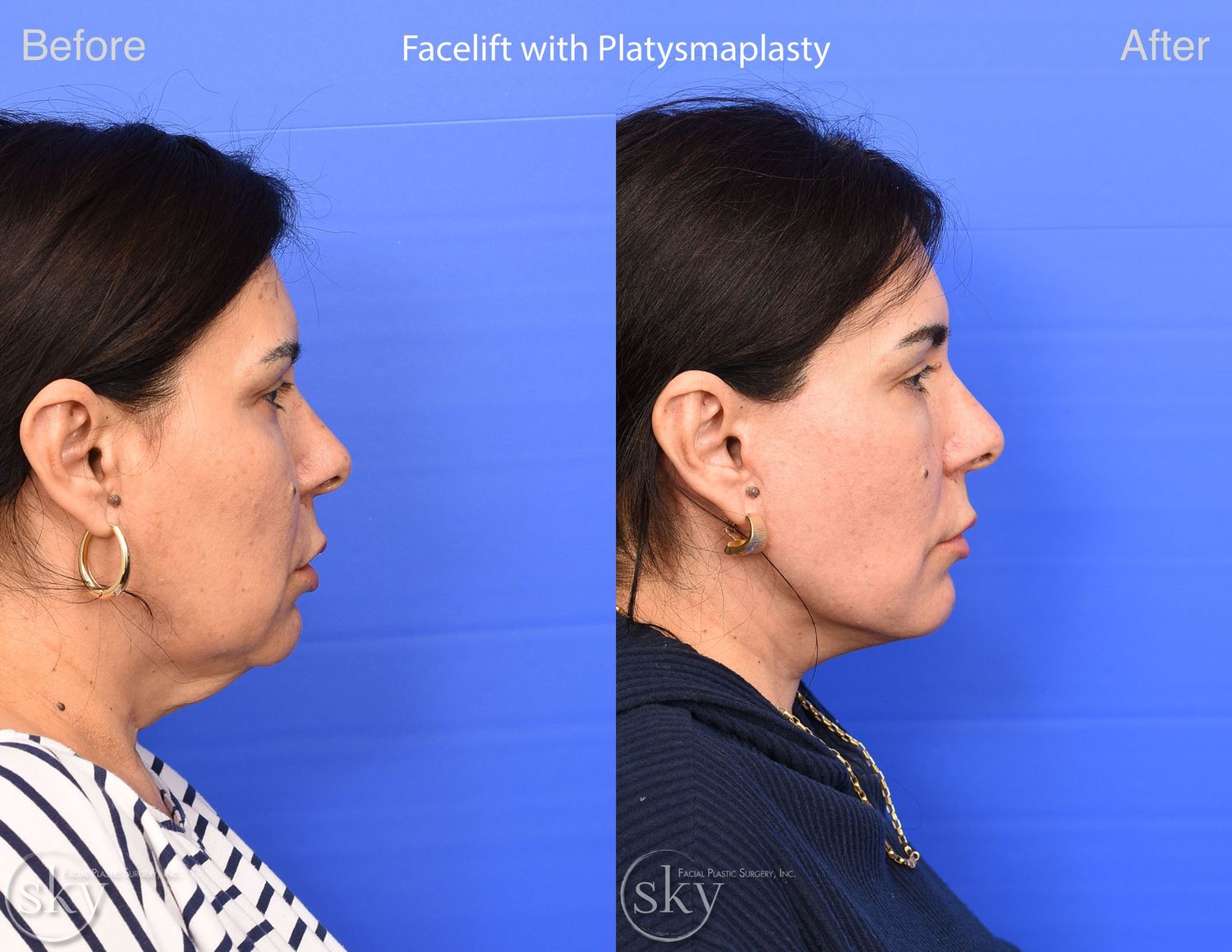 Facelift Before & After