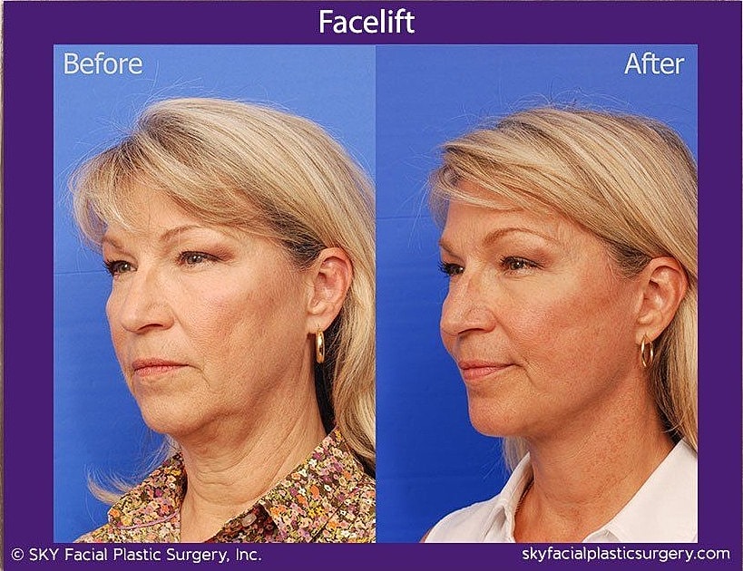 Facelift Before & After
