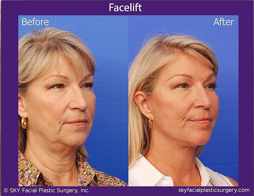 Facelift Before & After