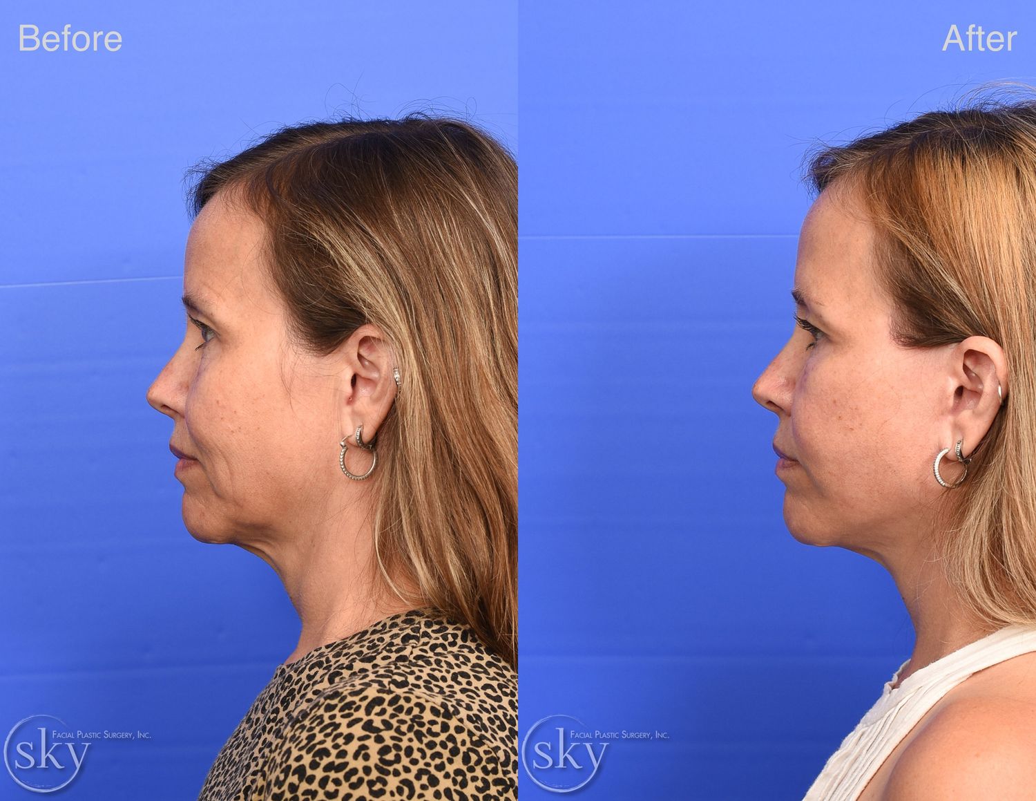 Facelift Before & After