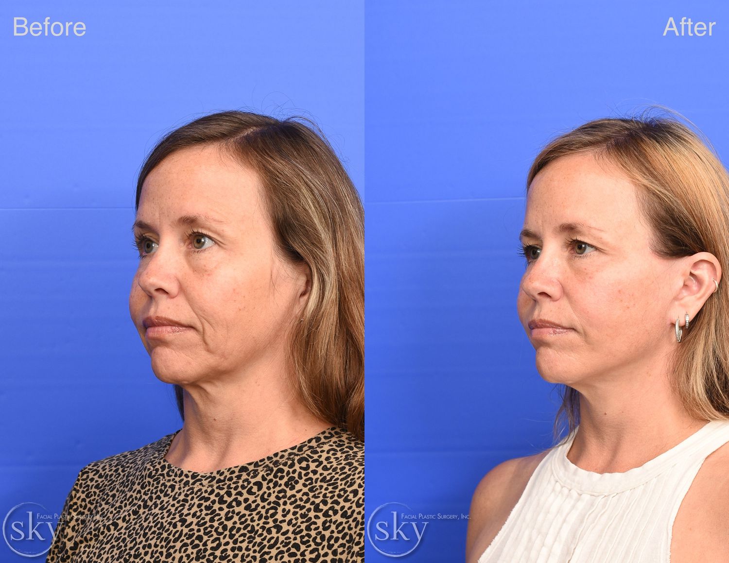 Facelift Before & After