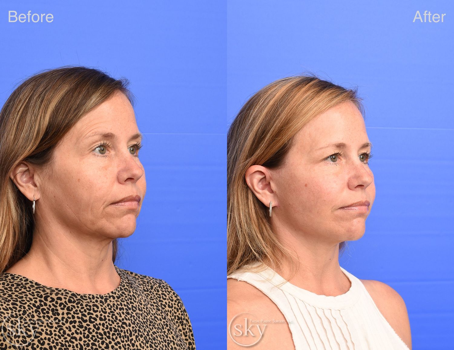 Facelift Before & After