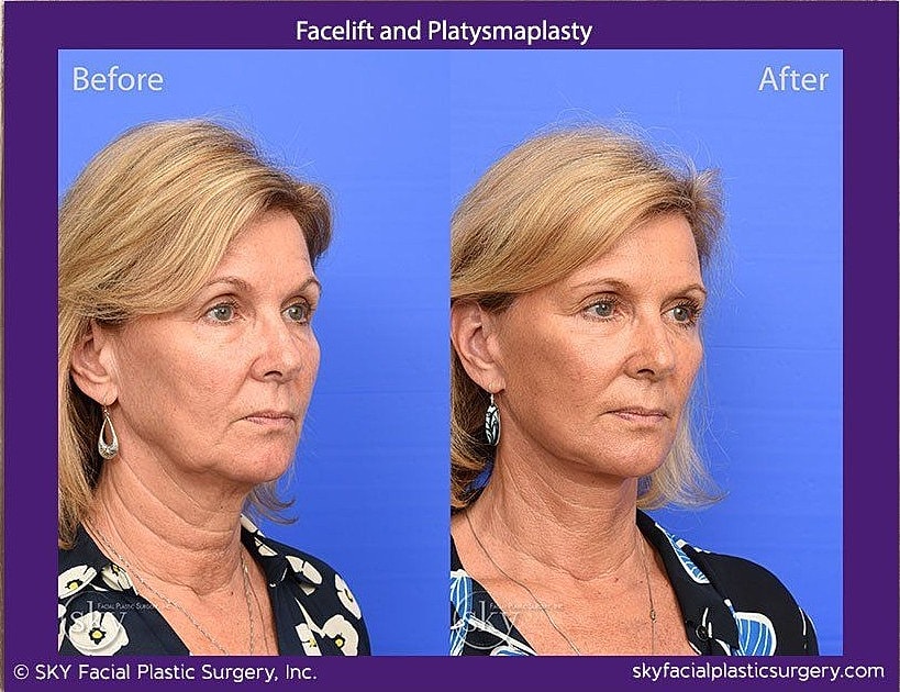 Facelift Before & After