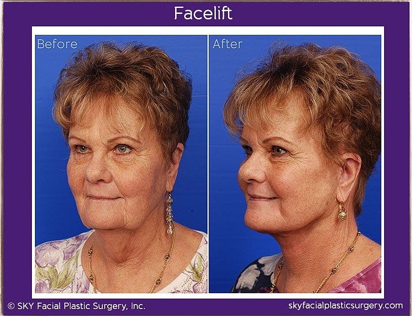 Facelift Before & After