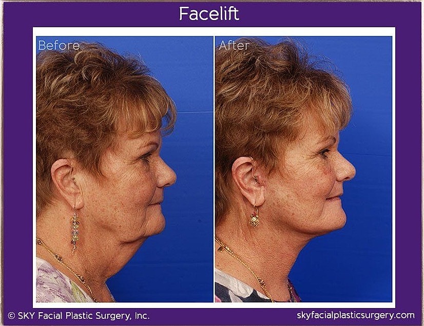 Facelift Before & After