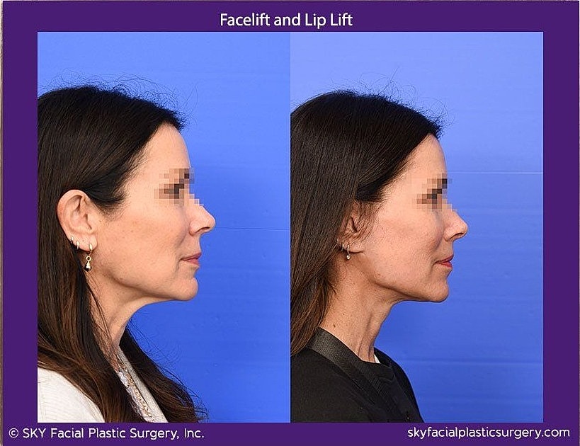 Facelift Before & After