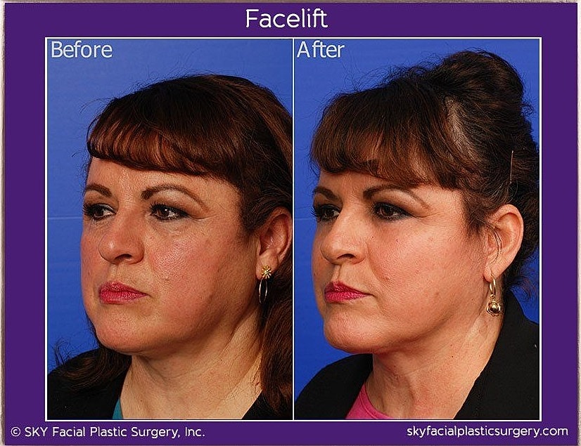 Facelift Before & After