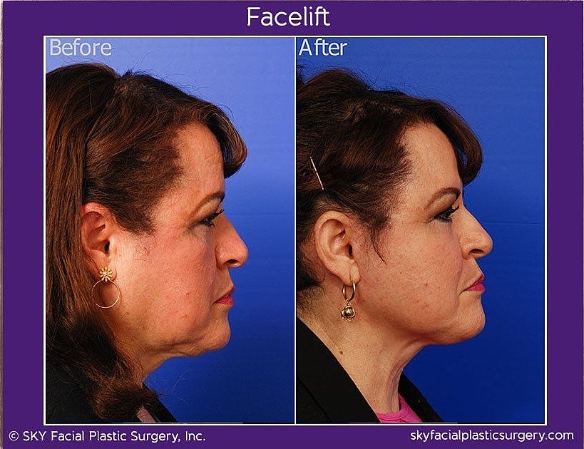 Facelift Before & After