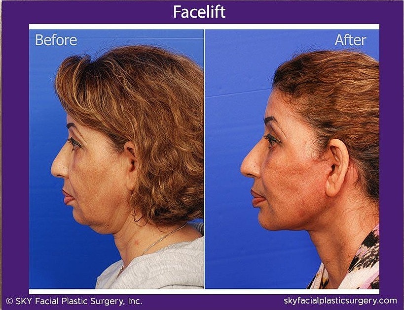 Facelift Before & After