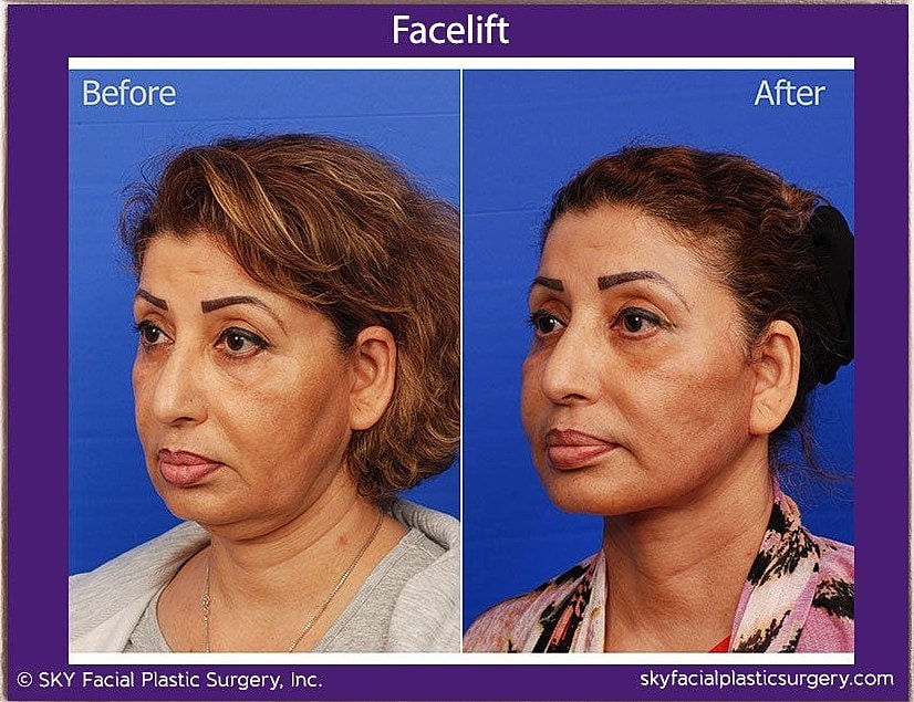 Facelift Before & After