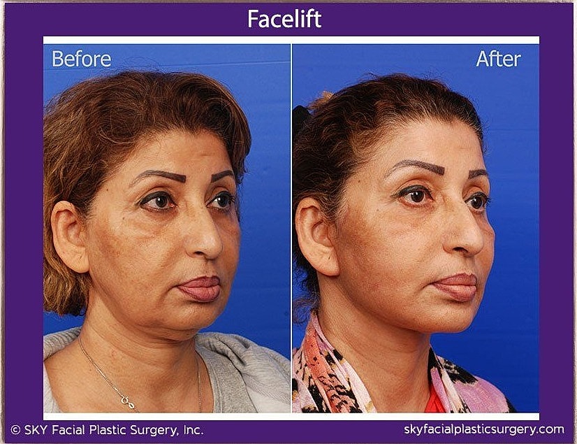 Facelift Before & After