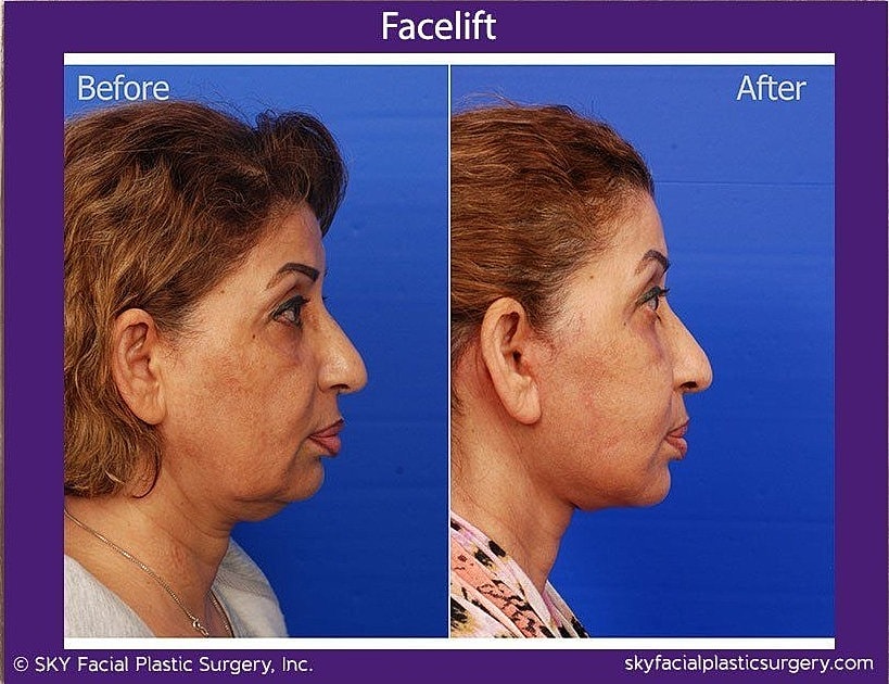 Facelift Before & After