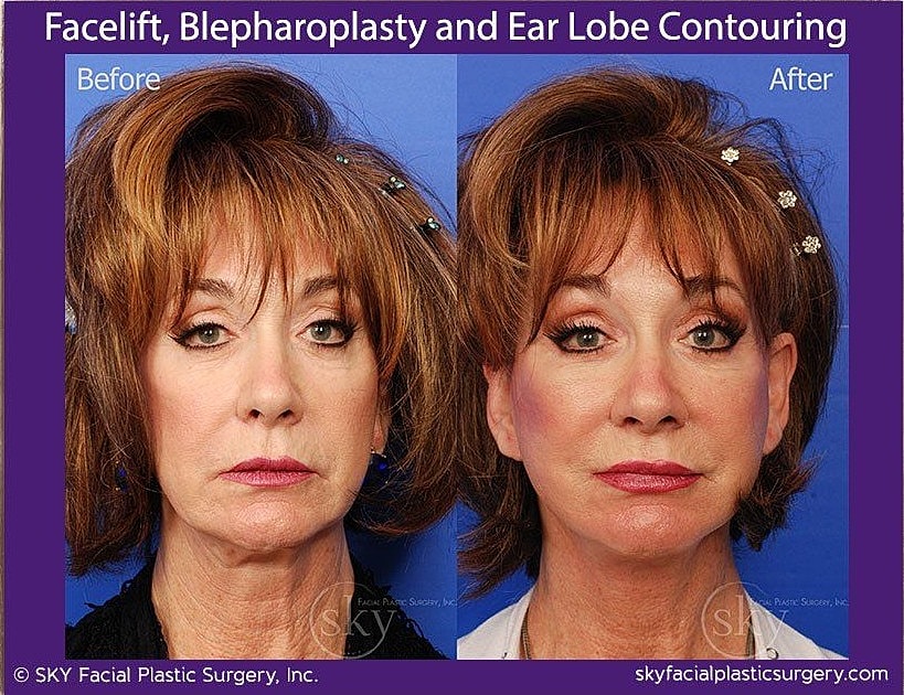 Facelift Before & After